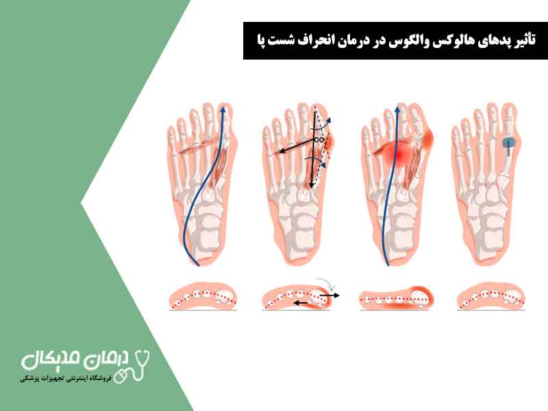 تأثیر پدهای هالوکس والگوس در درمان انحراف شست پا